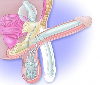 Penilná protéza obnoví erekciu a zväčší penis